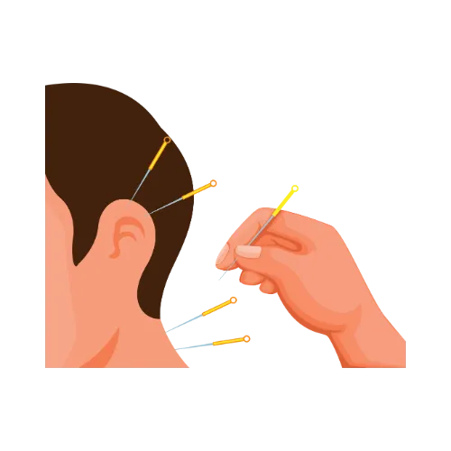 Acupuncture
