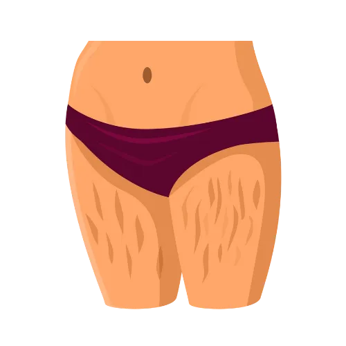 Scars & Stretch Marks